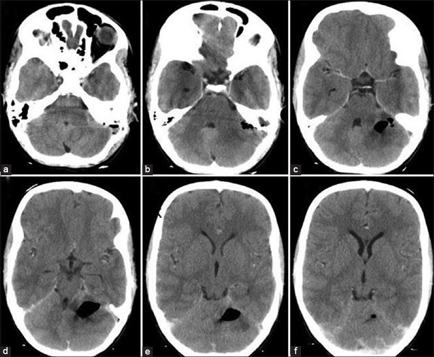 (a-f) Contrast enhanced computed tomography head axial cuts to rule out any abscess