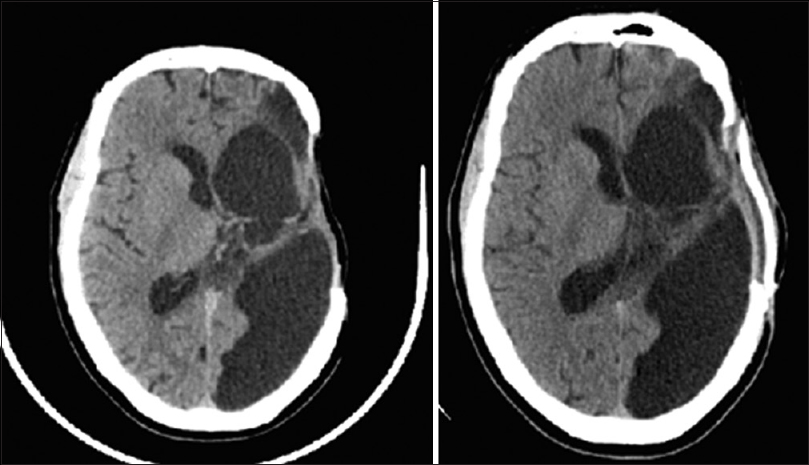 Axial, non-contrasted computed tomography of the head demonstrating preoperative (left) and post-operative (right) imaging after cranioplasty in a patient with plateau of speech rehabilitation