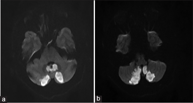 (a and b) MRI DWI shows bilateral inverted V shaped infarct in PICA territory