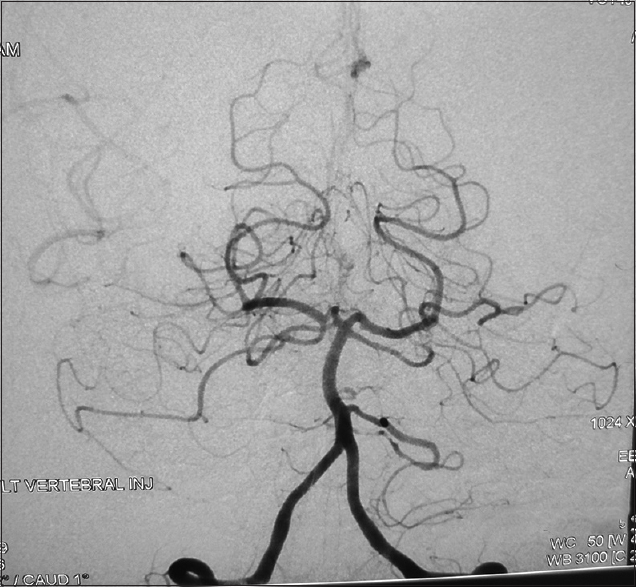 DSA shows bilateral PICA and right AICA occlusion