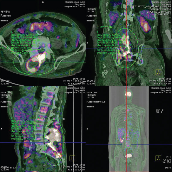 Positron emission tomography-computed tomography scan showed an isolated reactive zone on the right paravertebral side of L3-L4-L5