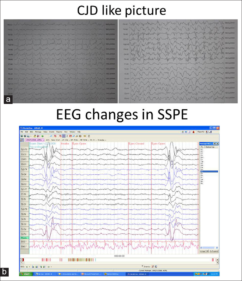 (a) Midpositive triphasic waves, sharp waves, and slow waves resembling creudzfeldt jakob disease in autoimmune encephalitis, (b) electroencephalographic showing classical periodic complexes in sub-acute sclerosing panencephalitis