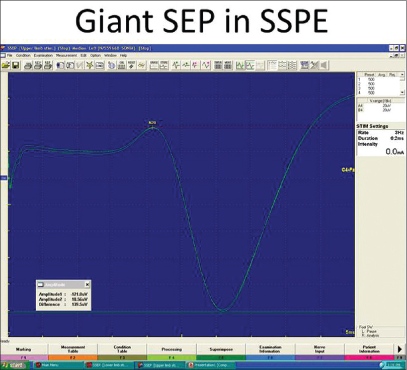 Giant sensory evoked potential seen in sub-acute sclerosing panencephalitis and not in autoimmune encephalitis