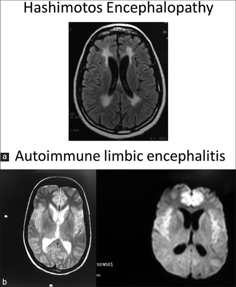 (a) Hashimoto's encephalopathy showing periventricular white matter changes (b) hyperintensities in cingulum and insular region seen in autoimmune encephalitis