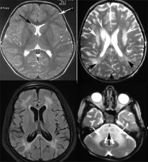 Magnetic resonance imaging images in sub-acute sclerosing panencephalitis showing white matter and cerebellar changes