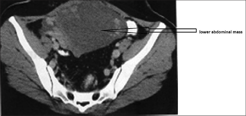 Computed tomogram pelvis with oral and intravenous contrast showing lower abdominal mass as shown by an arrow