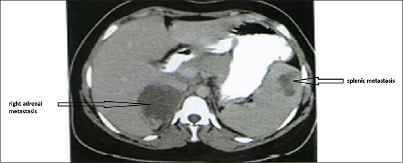 Computed tomogram abdomen with oral and intravenous contrast showing right adrenal and splenic metastases as shown by arrows