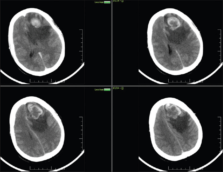 Computed tomogram brain contrast showing single metastasis