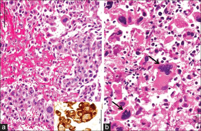 Microphotographs reveal cellular neoplasm with plump tumor cells in broad trabeculae separated by zones of hemorrhage and necrosis (a). The tumors cells are strongly labeled by cytokeratin (a, inset). There are several bizarre tumor giant cells seen (b, arrow). ([a] H and E, inset: Cytokeratin immunochemistry; [b] H and E) (magnification = scale bar)