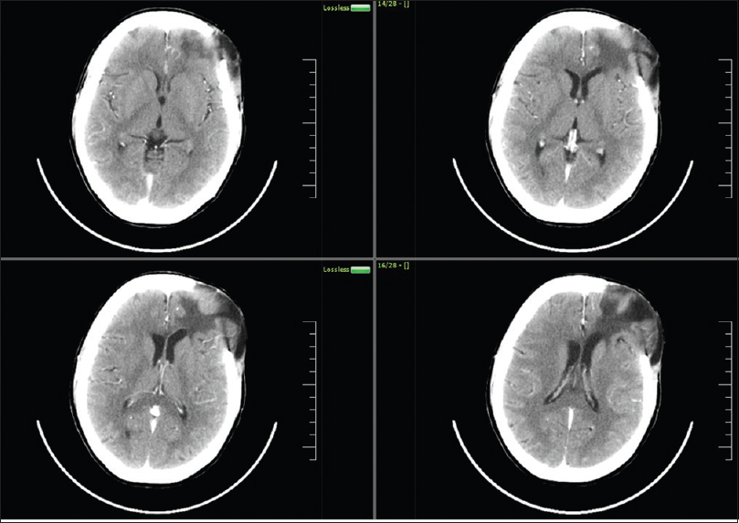 Postoperative computed tomogram contrast at the end of 1-year showing no recurrence