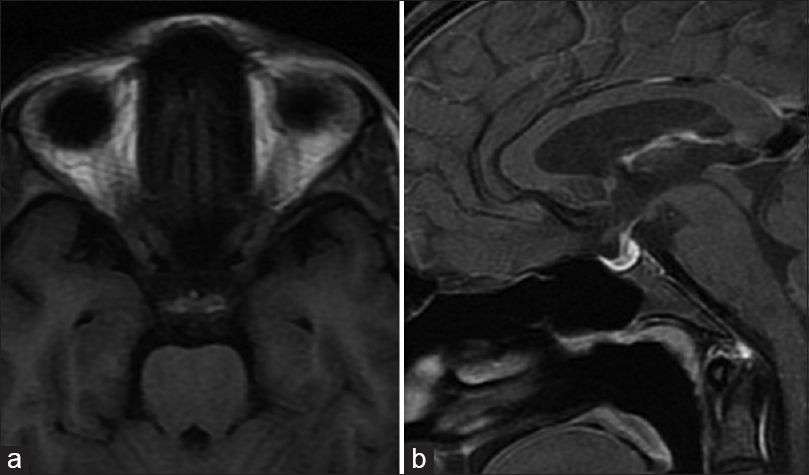 Magnetic resonance images from follow-up scan (3 months after initial scan). Axial T1-weighted (a) and sagittal gadoliniumenhanced fat saturated T1-weighted images (b) show resolution of the bleed with small sized (4 mm in height) relatively homogenously enhancing residual pituitary gland