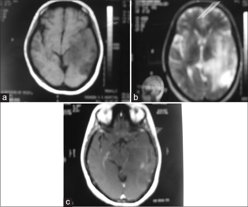 (a) T1-weighed magnetic resonance imaging brain showing ill-defined hypointense lesion. (b) T2-weighted magnetic resonance imaging showed an area of diffuse poorly defined high signal intensity with a variable degree of obliteration of sulci and gyri. (c) Contrast magnetic resonance imaging shows mild diffuse patchy enhancement