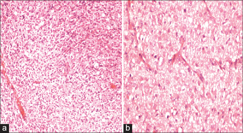 (a) H and E ×10 diffusely infiltrating small round to oval cells with pleomorphic nuclei. (b) H and E ×40 gemistocytic astrocytes and scattered mitotic figures