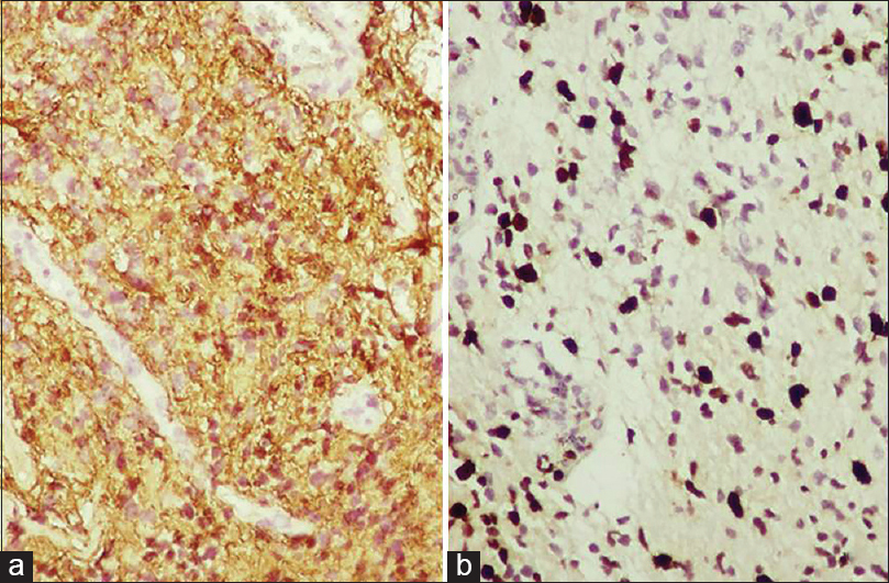 Immunohistochemistry of tumour cells showing GFAP positivity, Ki 67 labelling index- 40%