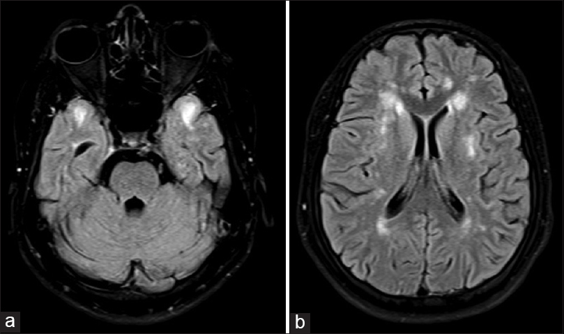 (a) Magnetic resonance imaging brain axial fluid-attenuated inversion recovery image shows anterior temporal lobe involvement characteristic of Cerebral Autosomal Dominant Arteriopathy with Subcortical Infarcts and Leukoencephalopathy, (b) magnetic resonance imaging brain axial fluid-attenuated inversion recovery image shows external capsule involvement