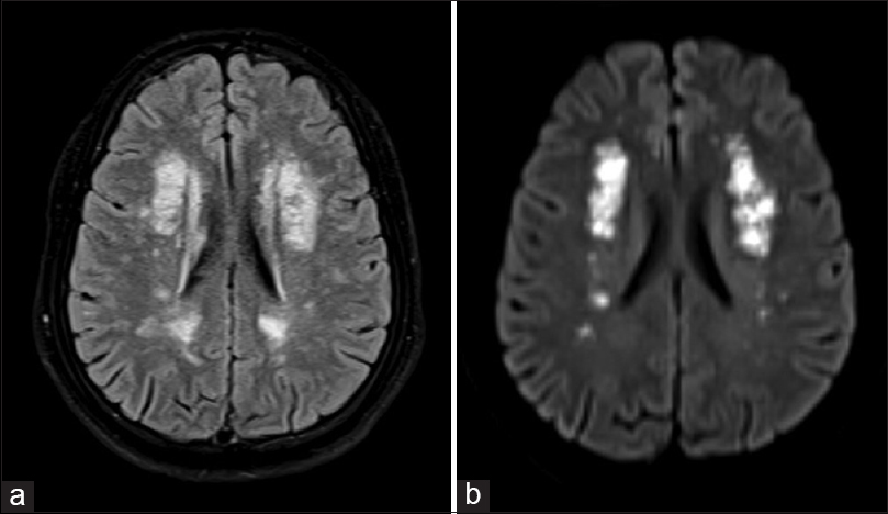 (a) Magnetic resonance imaging brain axial fluid-attenuated inversion recovery image shows extensive periventricular white matter hyperintense signals, (b) magnetic resonance imaging brain axial diffusion weighted imaging image shows acute infarcts in both centrum semiovale regions