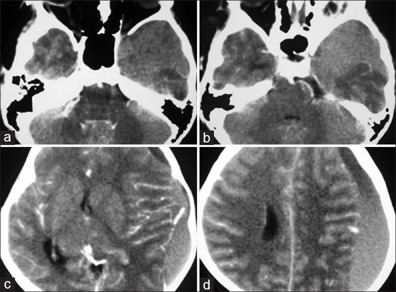 Contrast enhanced computed tomography showed left chronic subdural hematoma completely occupying temporal fossa (a and b), fronto parietal regions with gross midline shift and few areas of contrast enhancement (c and d)