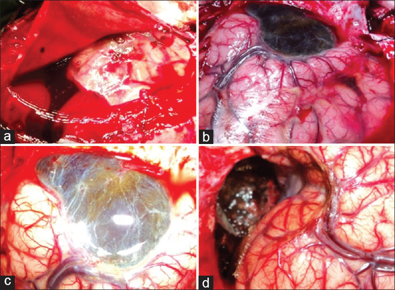 Intraoperative photographs showing collected subdural blood after opening the duramater (a), arachnoid cyst occupying the temporal pole and sylvian fissure before (b and c) and after (d) excision