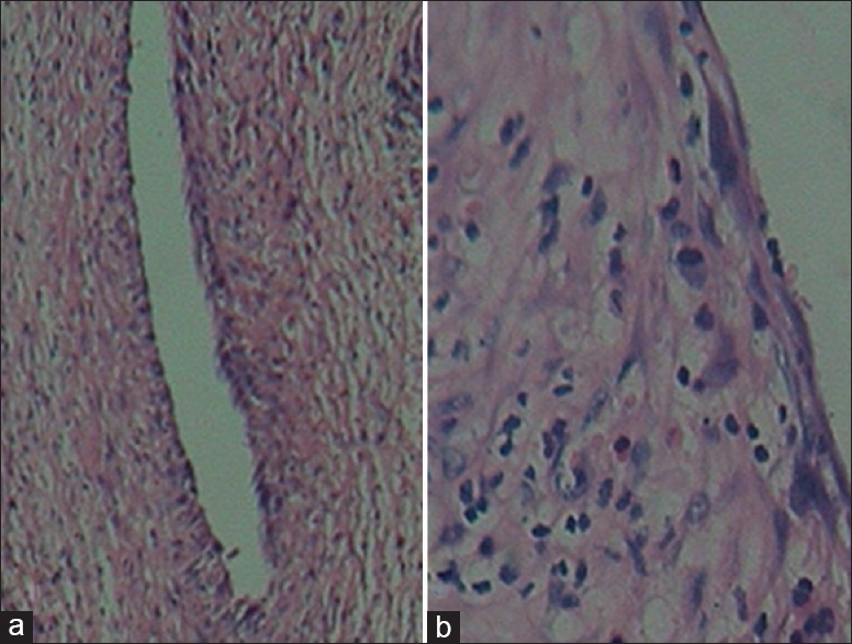 Microphotograph, H and E stain ×10 (a) and ×40 (b) the cyst wall lined by flattened to cuboidal cells supported by collagen