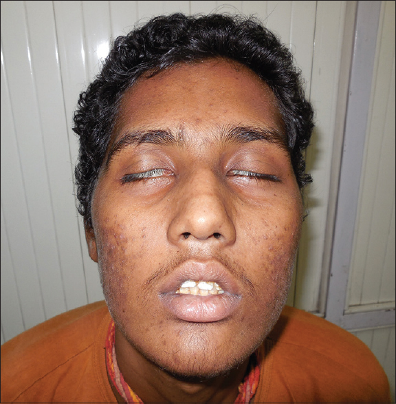 Bilateral lower motor neuron type of facial palsy (House and Brackmann Grade VI)