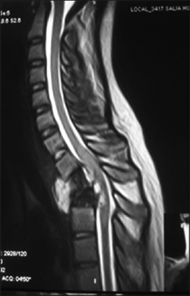 T2-weighted image showing destruction of Th2 and Th3 vertebra and the associated intervertebral discs