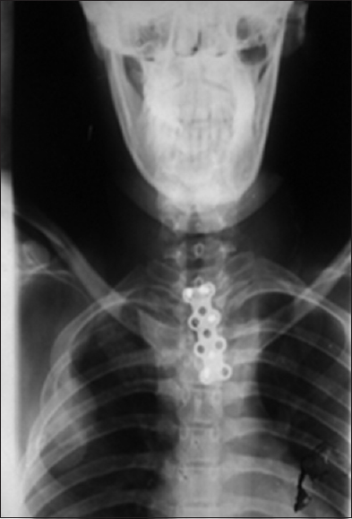 Postoperative X-ray showing position of plate