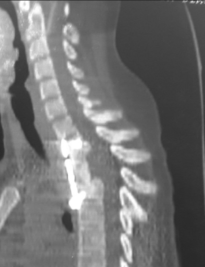 Postoperative, sagittal reformatted computed tomography scan showing restored axial alignment and position of plate