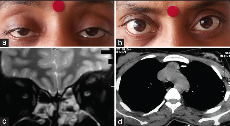 (a) Clinical photograph showing the presence of bilateral ptosis. (b) Magnetic resonance imaging orbit is showing the absence of any extraocular muscle thickening. (c) Marked improvement in ptosis after neostigmine administration (positive response). (d) High-resolution computerized tomography thorax revealing mildly enlarged thymus gland (white arrow)