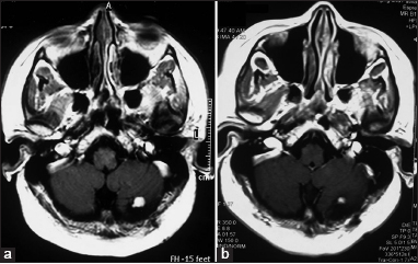 Axial gadolinium-enhanced magnetic resonance images of patient number 10 showing mural nodule with a small cyst (a). 1 year after radiosurgery, there was a significant decrease in the size of the mural nodule (b)