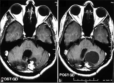 Axial gadolinium-enhanced magnetic resonance images of patient number 1 showing mural nodule with a small cyst (a). 1 year after radiosurgery, there was a decrease in the size of the mural nodule with increase in the cyst size (b) causing significant compression on the fourth ventricle