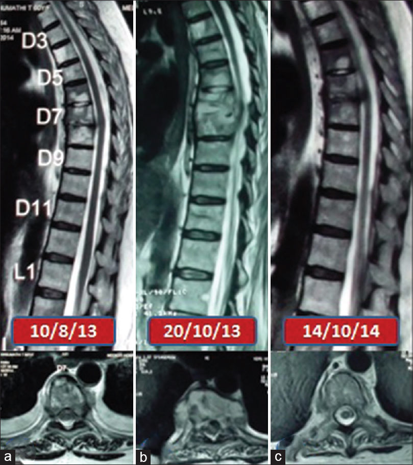 Serial images of patient 1 (a) sagittal and axial magnetic resonance images before starting antituberculous treatment (b) sagittal and axial magnetic resonance images showing paradoxical increase 3 months after starting antituberculous treatment (c) sagittal and axial magnetic resonance images showing resolution of lesion at completion of antituberculous treatment