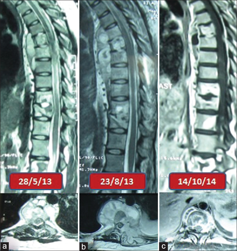 Serial images of patient 3 (a) sagittal and axial magnetic resonance images before starting antituberculous treatment (b) sagittal and axial magnetic resonance images showing paradoxical increase 3 months after starting antituberculous treatment (c) sagittal and axial magnetic resonance images showing resolution of lesion at completion of antituberculous treatment