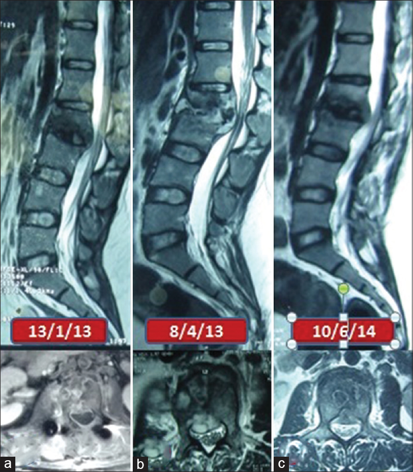 Serial images of patient 6 (a) sagittal and axial magnetic resonance images before starting antituberculous treatment (b) sagittal and axial magnetic resonance images showing paradoxical increase 3 months after starting antituberculous treatment (c) sagittal and axial magnetic resonance images showing resolution of lesion at completion of antituberculous treatment