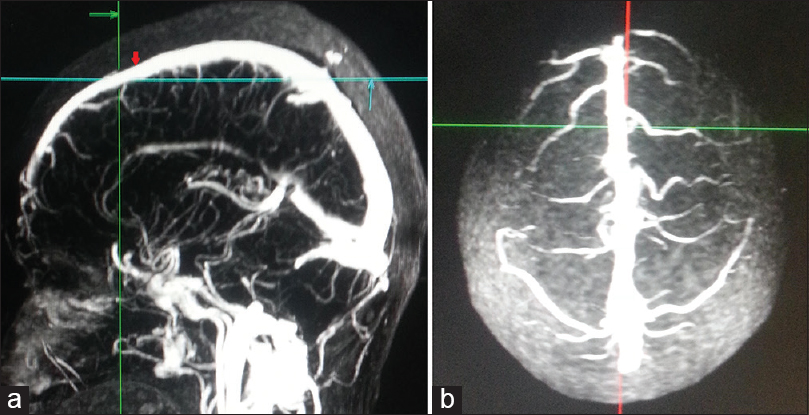 Methodology to mark anterior third superior sagittal sinus. (a) Point at the level of coronal suture on superior sagittal sinus was marked (red arrow) in midsagittal three-dimensional contrast-enhanced magnetic resonance venogram. 1 cm anterior to it marks the posterior limit of anterior third superior sagittal sinus (intersection of green and blue lines). (b) Corresponding superior view showing anterior third of superior sagittal sinus