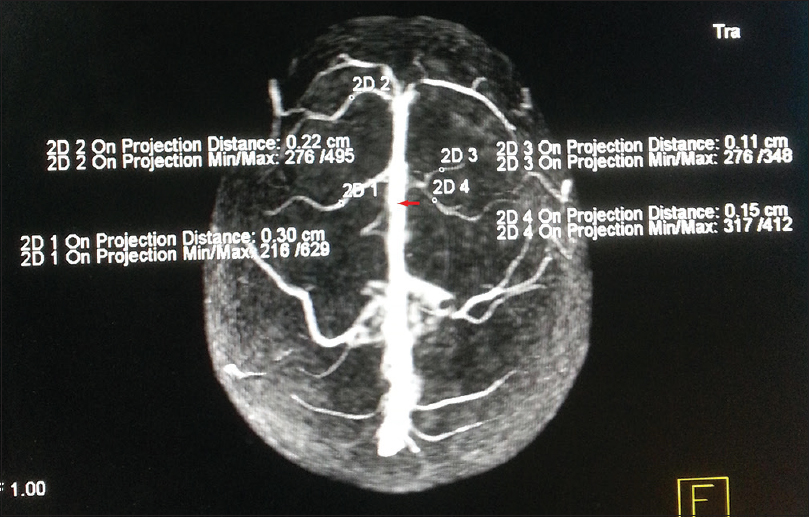 Superior view of three-dimensional contrast-enhanced magnetic resonance venogram showing multiple cortical veins draining to anterior third of superior sagittal sinus. The caliber of draining veins has been measured in a millimeter at its midpoint of the visible length (marked by small circles). The posterior limit of anterior third of superior sagittal sinus has been marked with red arrows