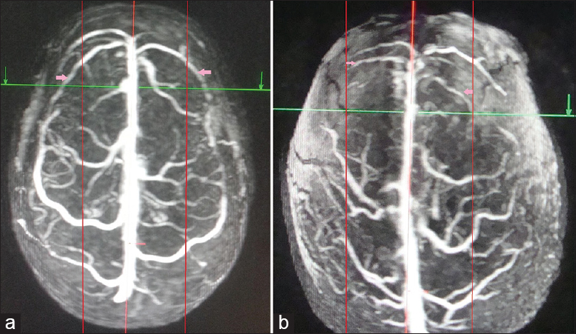 Superior view of three-dimensional contrast-enhanced magnetic resonance venogram of two different individuals showing varying areas of drainage to anterior third of superior sagittal sinus, proportional to the length of cortical veins. The posterior limit of anterior third of superior sagittal sinus has been marked with intersection of green line and red midline. (a) Long draining veins (pink arrows) in the anterior third of superior sagittal sinus crossing half the lateral surface of the frontal lobe (marked by 2 red paramedian lines). (b) Short draining veins (pink arrows) to anterior third of superior sagittal sinus, the length limited to the red parallel lines. The posterior limit of anterior third of superior sagittal sinus has been marked with red arrows