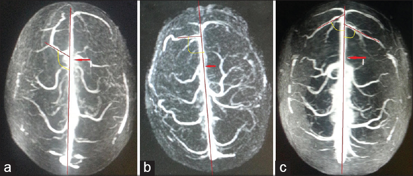 Superior view of three-dimensional contrast-enhanced magnetic resonance venogram of three different individuals showing the angle of drainage of cortical veins into the anterior third of superior sagittal sinus. The posterior angle of the draining vein into anterior third of superior sagittal sinus has been marked with yellow arcs. The angle is measured between the line along the major draining vein and the line along the superior sagittal sinus (Red arrow). (a) Acute angle, (b) right angle, (c) obtuse angle. The posterior limit of anterior third of superior sagittal sinus has been marked with red arrows