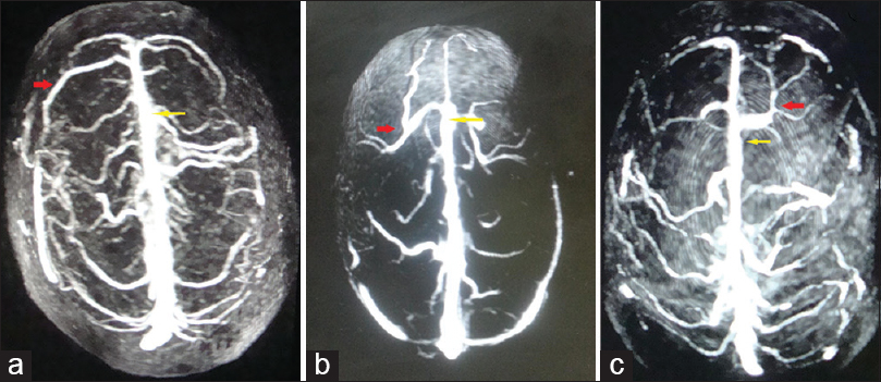 Superior view of three-dimensional contrast-enhanced magnetic resonance venogram of three different individuals showing draining veins to anterior third of superior sagittal sinus and its various branching patterns. The posterior limit of anterior third of superior sagittal sinus has been marked with yellow arrows. (a) No branching of draining veins at anterior third of superior sagittal sinus. (b) Twin branching (red arrow) of draining veins at anterior third of superior sagittal sinus. (c) Multiple branching (red arrow) of draining vein at anterior third of superior sagittal sinus