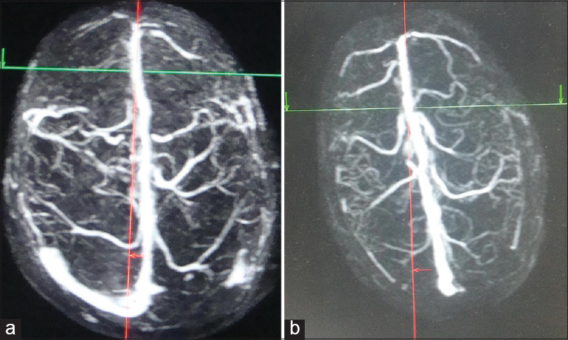 Superior view three-dimensional contrast-enhanced magnetic resonance venogram of different individuals categorized into different risk groups based on our risk stratification criteria. The posterior limit of anterior third of superior sagittal sinus has been marked with intersection of red and green lines. (a) Safe for ligation of anterior third of superior sagittal sinus. (b) Relatively safe for anterior third of superior sagittal sinus ligation (commonest variant)