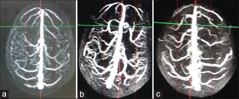 Superior view three-dimensional contrast-enhanced magnetic resonance venogram of 3 different individuals (a-c) categorized into high-risk groups based on our risk stratification criteria. The posterior limit of anterior third of superior sagittal sinus has been marked with red arrows