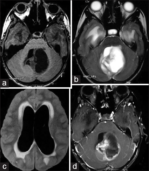 Axial magnetic resonance images of the brain showing (a and b) mixed intensity partly solid and partly cystic intra-axial midline posterior fossa tumor; (c) hydrocephalus with periventricular lucency on fluid attenuation inversion recovery images; and (d) heterogeneous enhancement of the lesion on contrast