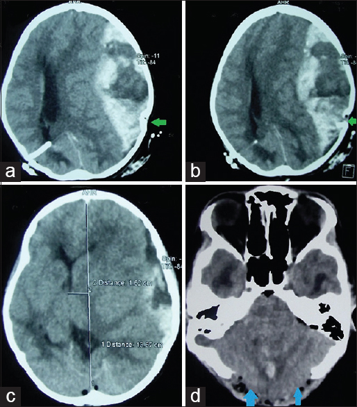 Immediate postoperative computed tomography scan showing (a and b) large hyperacute extradural hematoma on the left side with depressed fracture of the parietal bone driven inward (green arrows) and an external ventricular drain placed on the right side; (c) midline shift of 1.62 cm with effaced cisterns; and (d) cerebellum bulging out through the craniotomy defect (blue arrows) with small amount of operative site bleed