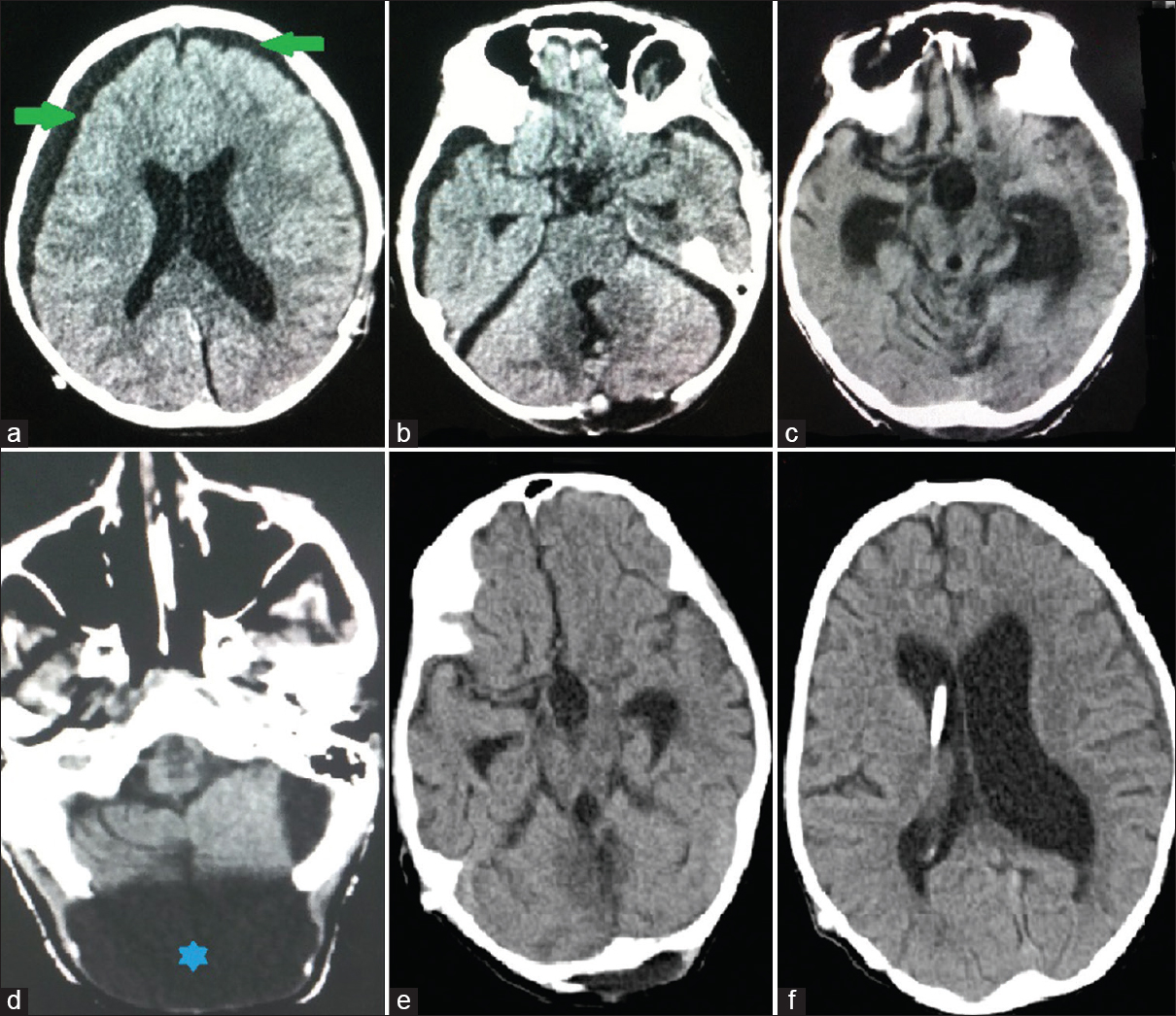 Axial computed tomography cuts 2 weeks after surgery (a and b) showing no residual clot, collapsed ventricles and bilateral subdural hygromas (green arrows); 6 weeks after surgery showing (c) dilated lateral and third ventricles, and (d) large occipitocervical pseudomeningocele (blue star); and 6 weeks after ventriculoperitoneal shunt and prior to discharge (e and f) showing regression of ventricular size and shunt tube in situ