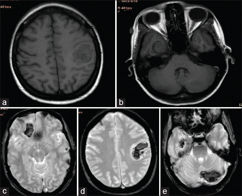 Magnetic resonance imaging brain; (a and b) T1-weighted images-showing hypo-intense lesion in the left parietal and right temporal lobe; (c-e) T2 FFE images – showing hypo-intense lesion in the paramedian right frontal, left parietal, right temporal, and right cerebellar lobe