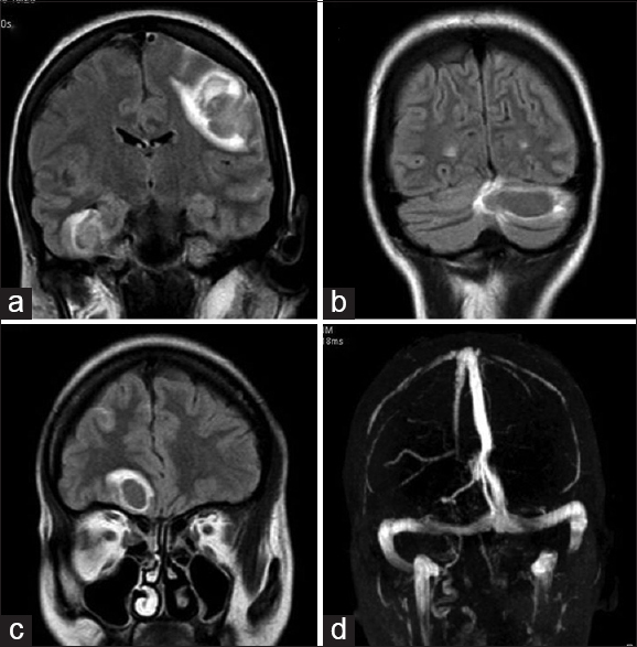 Magnetic resonance imaging brain; (a-c) fluid-attenuated inversion-recovery images - showing fluid-attenuated inversion-recovery hyper-intensity, abnormal gradient susceptibility and patchy areas of peripheral restricted water diffusion in the paramedian right frontal lobe, left parietal lobe, left cerebellar hemisphere and right temporal lobe. (d) Magnetic resonance venogram of brain vessels was normal