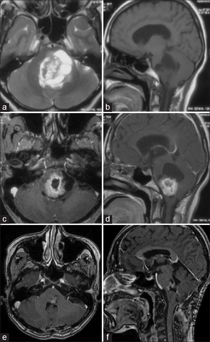 (a-d) Preoperative magnetic resonance imaging, (a) T2-weighted axial, (b) precontrast T1-weighted sagittal, (c) postcontrast T1-weighted axial, (d) postcontrast T1-weighted sagittal, showing a well-demarcated, intra-axial, solid-cystic tumor involving pons and medulla. (e and f) Magnetic resonance imaging at 6 months follow-up, postcontrast T1-weighted axial (e), and sagittal (f) images, showing small enhancing residual tumor component at left pontomedullary junction