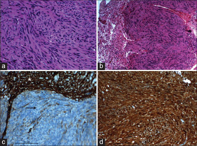 (a) Microphotograph showing the twisted/buckled nuclear characters of the spindle cells and the fibrillated cytoplasm (H and E, ×400); (b) microphotographs showing the neoplasm focally infiltrating the glial parenchyma (H and E, ×200); (c) microphotograph showing the tumors cells not stained with glial fibrillary acidic protein (black arrow), however the stain highlights the adjacent glial tissue (asterisk) (IHC stain glial fibrillary acidic protein, ×200); (d) microphotograph showing the tumor cells stained with S100 (IHC S100, ×200)