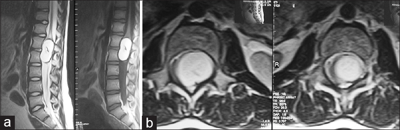 Magnetic resonance imaging of lumbar spine; (a) sagittal T2-weighted and (b) axial T2-weighted images showing a well-delineated, intramedullary, 2 cm × 4 cm mass at the L1-2 levels of the lumbar spine