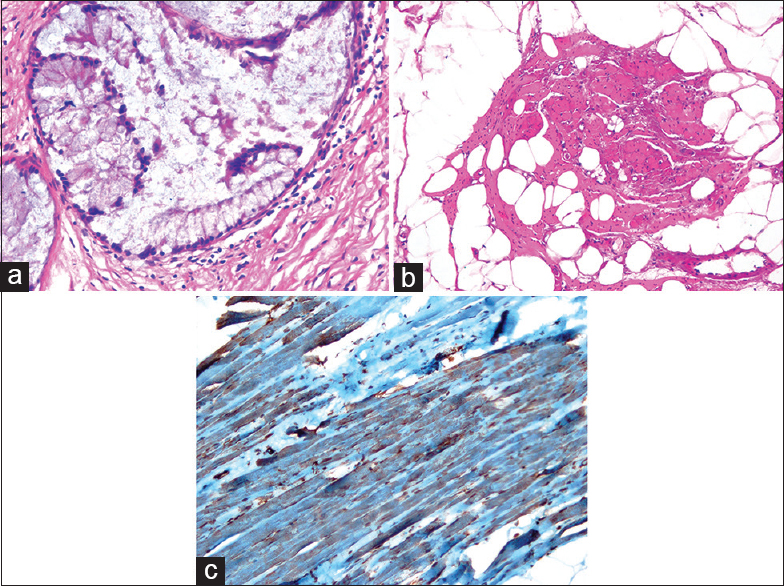 (a) Photomicrograph (H and E, ×40) showing connective tissue containing mucinous epithelium (b) photomicrograph (H and E, ×20) showing adipose tissue containing mature muscle cells (c) photomicrograph (IHC, ×40) showing smooth muscle cells reacted positively with actin