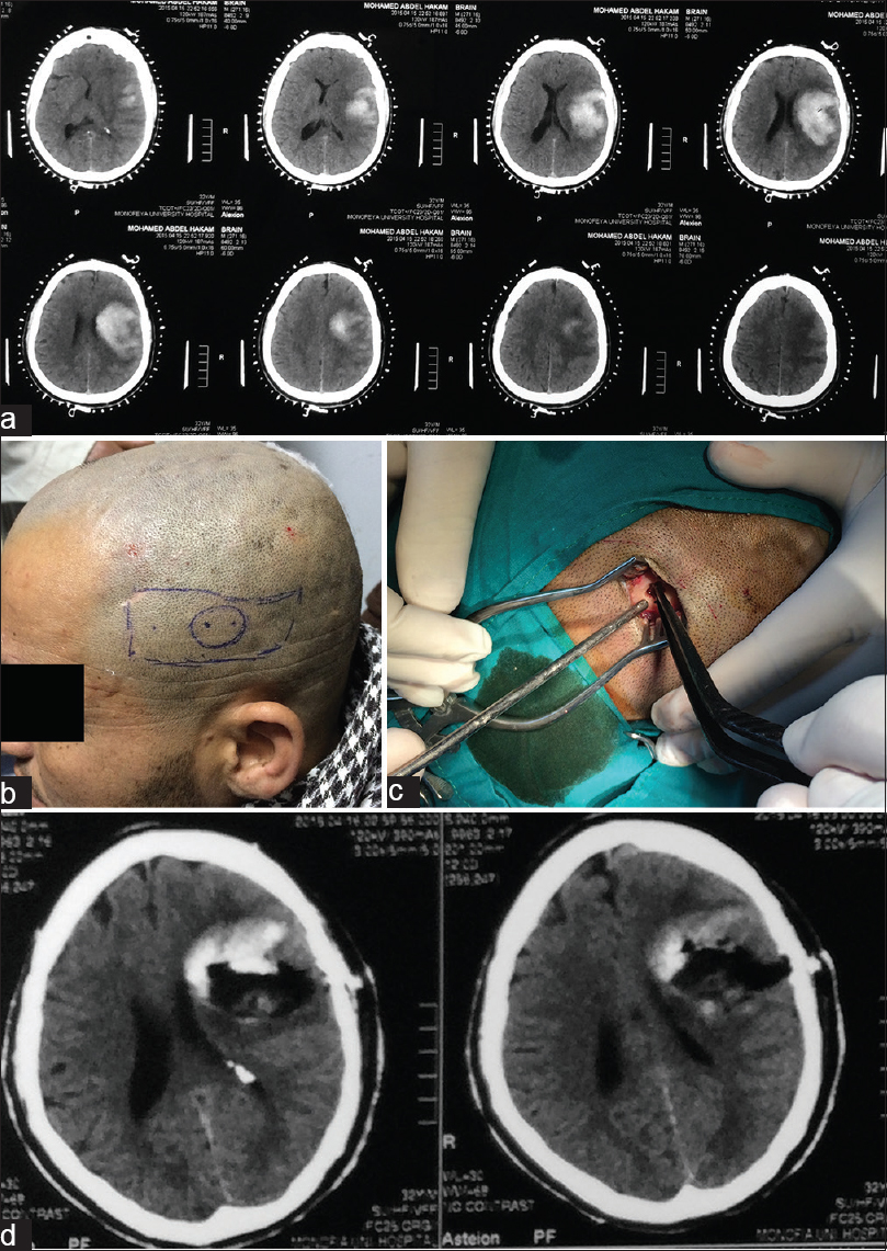 (a) Computed tomography scans show large left mid and high parietal intracerebral hematoma with midline shift, (b) scalp markers on patient's head as rectangular mark is the hematoma, the circular mark is site proposed to be around the bur hole, and the two pints is the sites to place brain cannula, (c) the tinny burr hole used to evacuate hematoma, and (d) computed tomography scans show highly significantly evacuated large hematoma with subsequently resolved midline shift